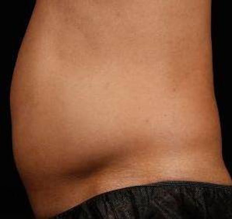 Liposuction Before & After Gallery - Patient 149435 - Image 3 - Scott Chapin, MD