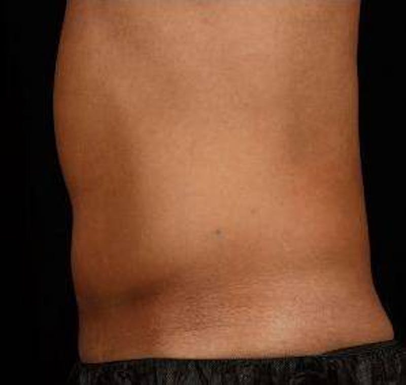 Liposuction Before & After Gallery - Patient 149435 - Image 4 - Scott Chapin, MD