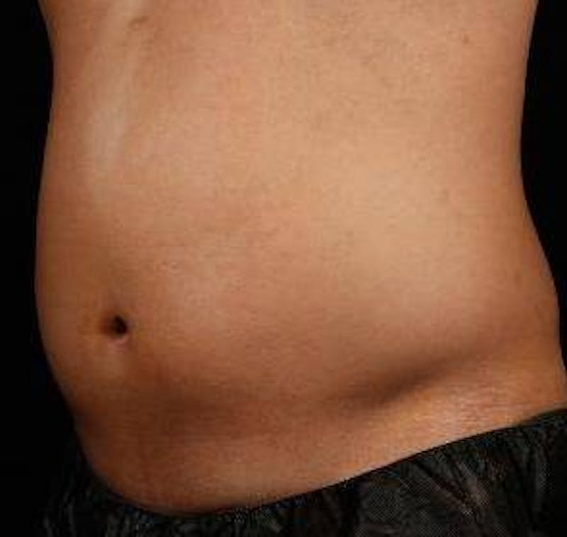 Liposuction Before & After Gallery - Patient 149435 - Image 5 - Scott Chapin, MD