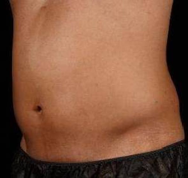 Liposuction Before & After Gallery - Patient 149435 - Image 6 - Scott Chapin, MD