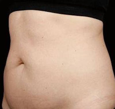 Liposuction Before & After Gallery - Patient 303794 - Image 1 - Scott Chapin, MD