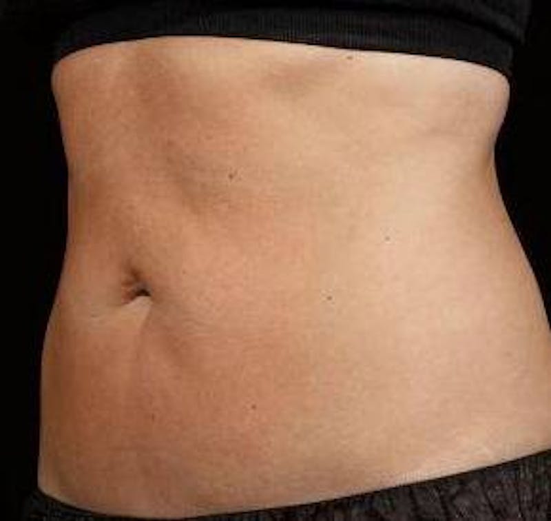 Liposuction Before & After Gallery - Patient 303794 - Image 2 - Scott Chapin, MD
