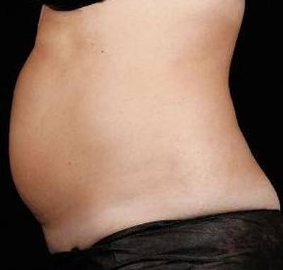 Liposuction Before & After Gallery - Patient 168954 - Image 1 - Scott Chapin, MD