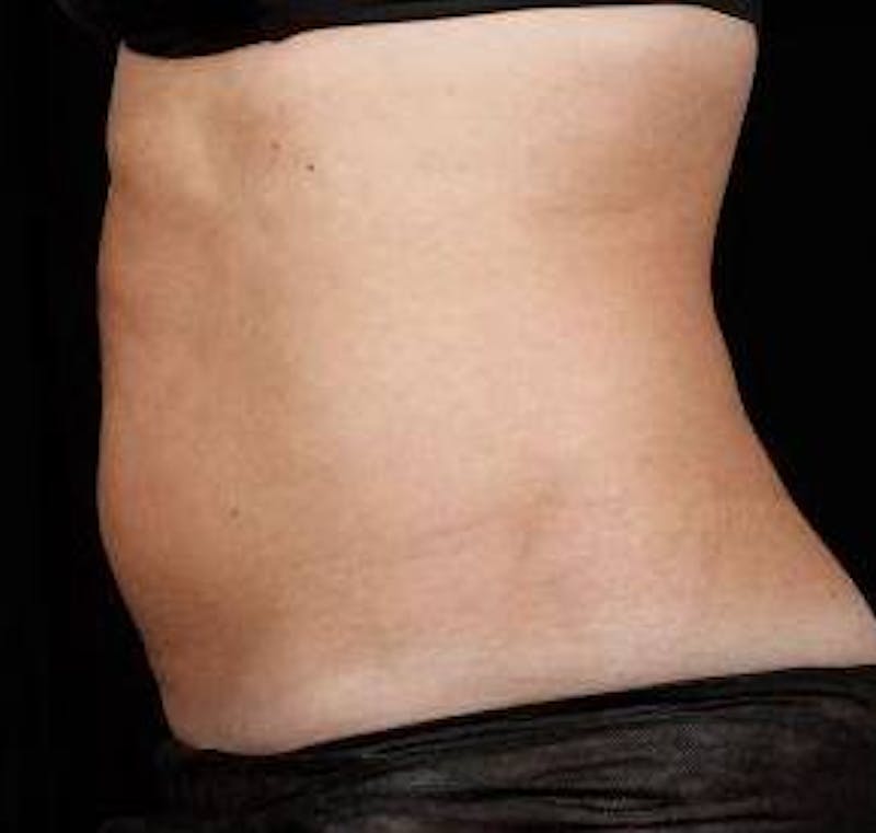 Liposuction Before & After Gallery - Patient 168954 - Image 2 - Scott Chapin, MD