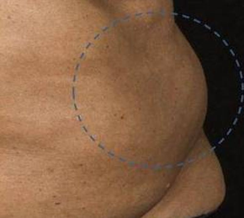 Liposuction Before & After Gallery - Patient 609283 - Image 1 - Scott Chapin, MD