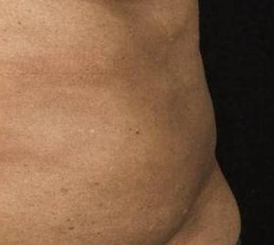 Liposuction Before & After Gallery - Patient 609283 - Image 2 - Scott Chapin, MD