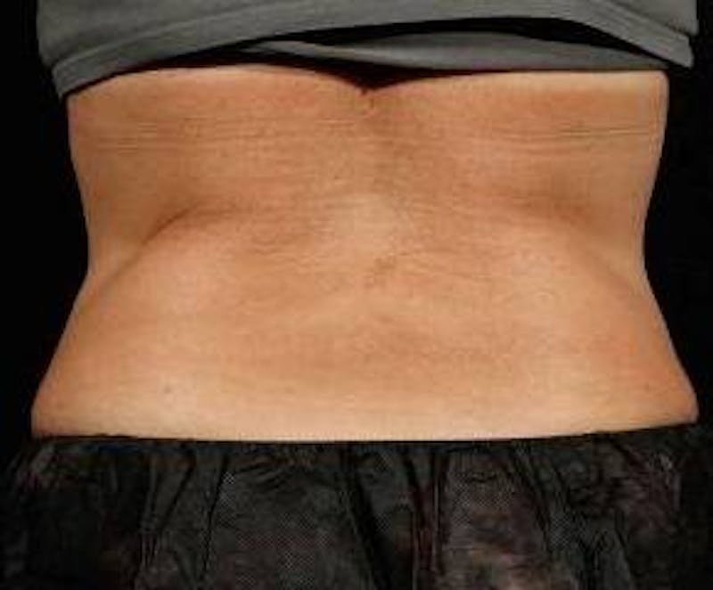 Liposuction Before & After Gallery - Patient 118001 - Image 1 - Scott Chapin, MD
