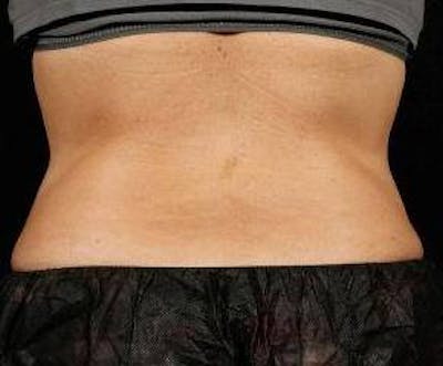 Liposuction Before & After Gallery - Patient 118001 - Image 2 - Scott Chapin, MD