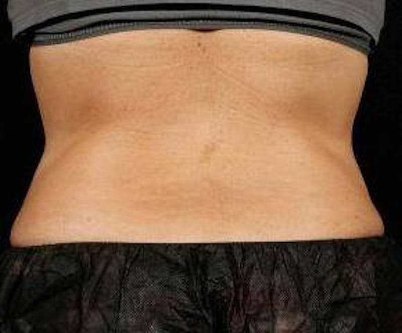 Liposuction Before & After Gallery - Patient 118001 - Image 2 - Scott Chapin, MD