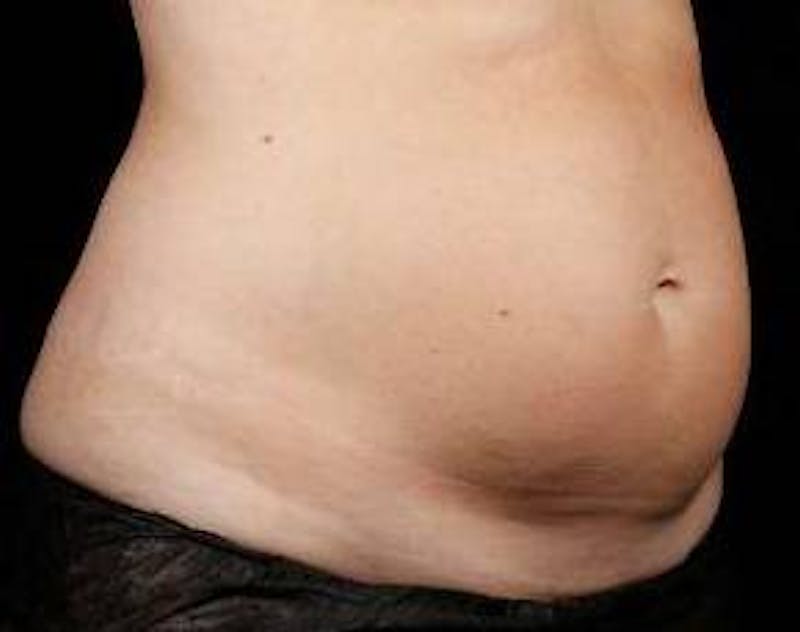 Liposuction Before & After Gallery - Patient 227074 - Image 1 - Scott Chapin, MD