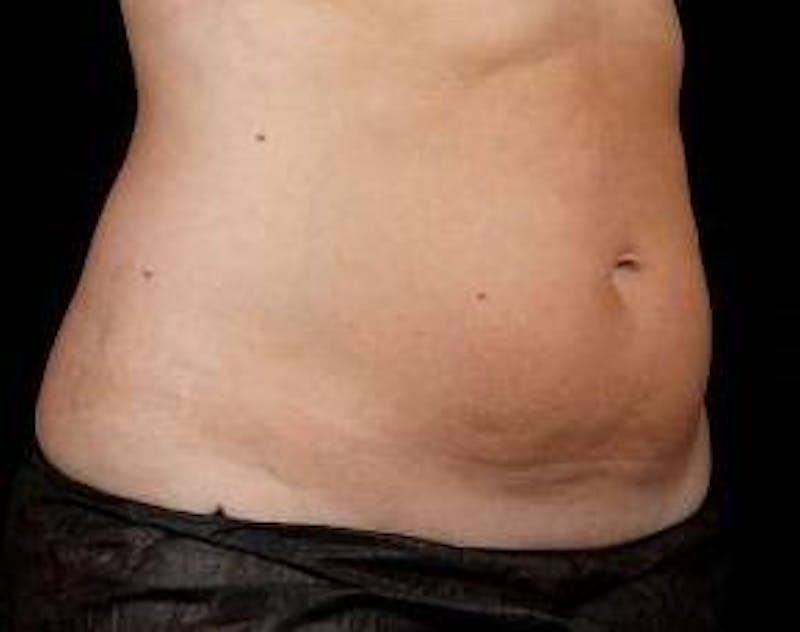 Liposuction Before & After Gallery - Patient 227074 - Image 2 - Scott Chapin, MD