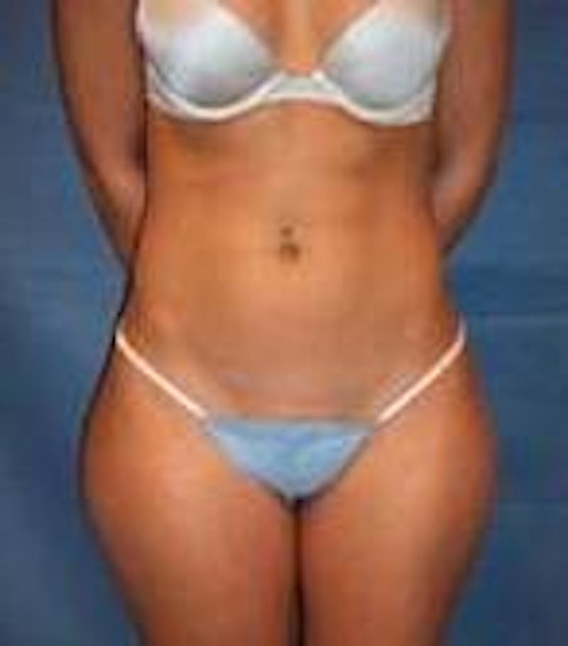 Liposuction Before & After Gallery - Patient 834224 - Image 1 - Scott Chapin, MD