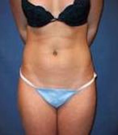 Liposuction Before & After Gallery - Patient 834224 - Image 2 - Scott Chapin, MD