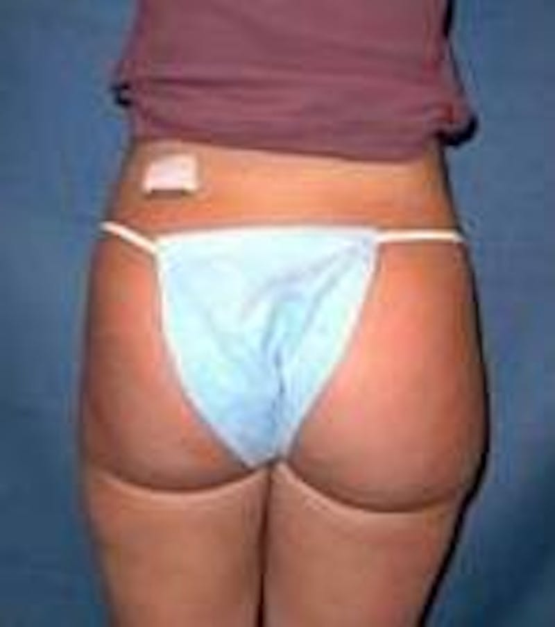 Liposuction Before & After Gallery - Patient 834224 - Image 4 - Scott Chapin, MD