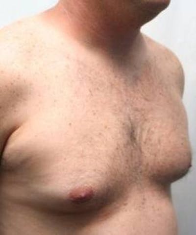 Liposuction Before & After Gallery - Patient 920823 - Image 1 - Scott Chapin, MD