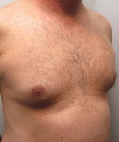 Liposuction Before & After Gallery - Patient 920823 - Image 2 - Scott Chapin, MD