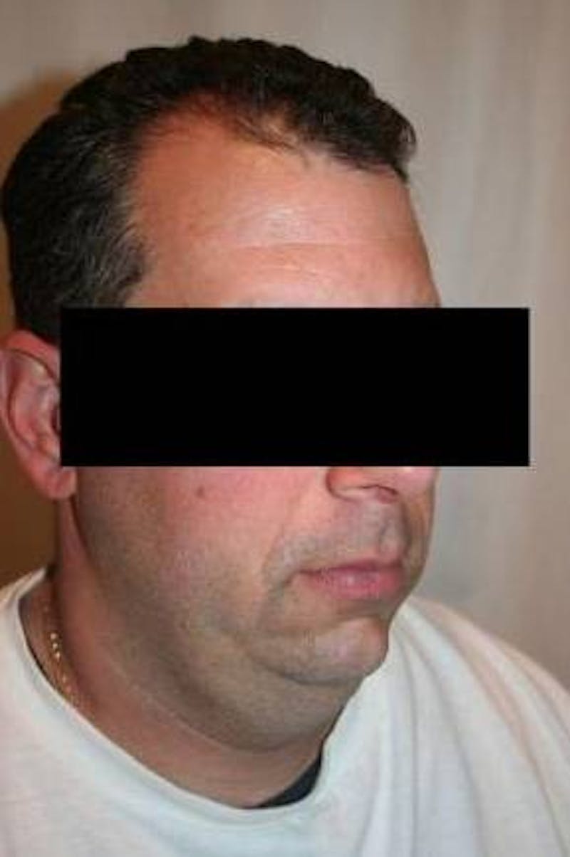 Liposuction Before & After Gallery - Patient 324824 - Image 1 - Scott Chapin, MD