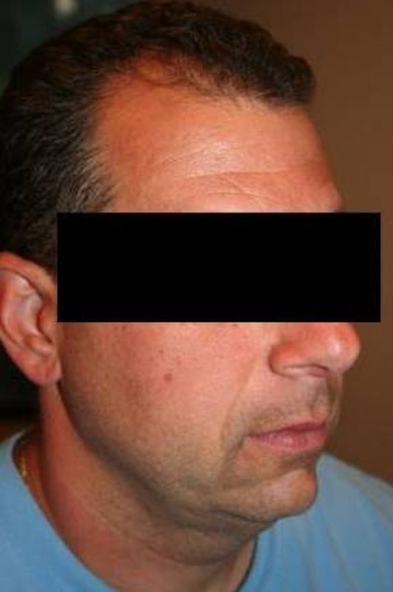 Liposuction Before & After Gallery - Patient 324824 - Image 2 - Scott Chapin, MD