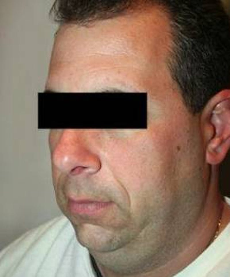 Liposuction Before & After Gallery - Patient 324824 - Image 3 - Scott Chapin, MD