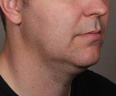 Liposuction Before & After Gallery - Patient 110585 - Image 1 - Scott Chapin, MD