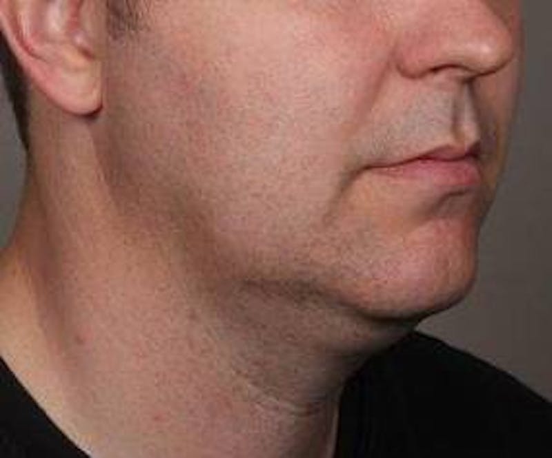Liposuction Before & After Gallery - Patient 110585 - Image 1 - Scott Chapin, MD