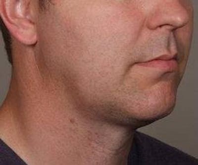 Liposuction Before & After Gallery - Patient 110585 - Image 2 - Scott Chapin, MD