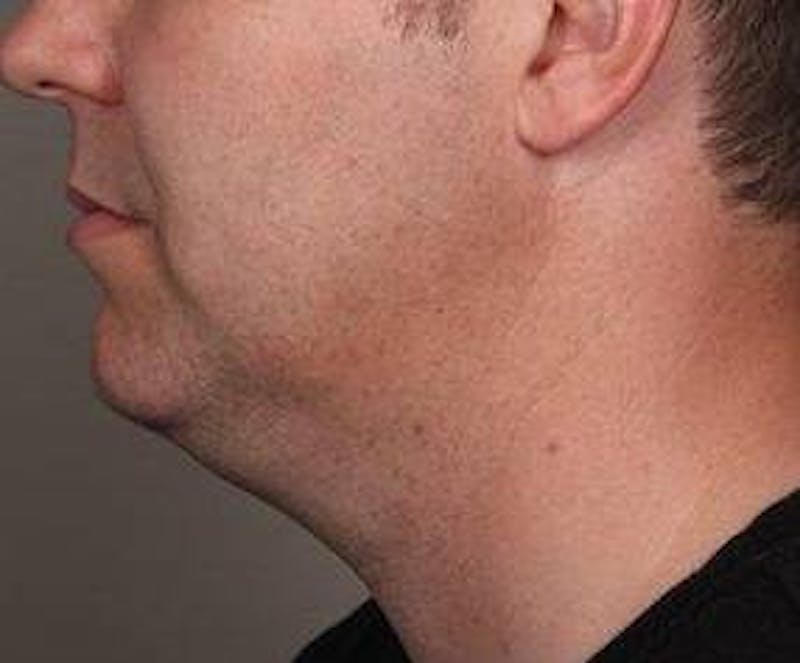 Liposuction Before & After Gallery - Patient 110585 - Image 3 - Scott Chapin, MD