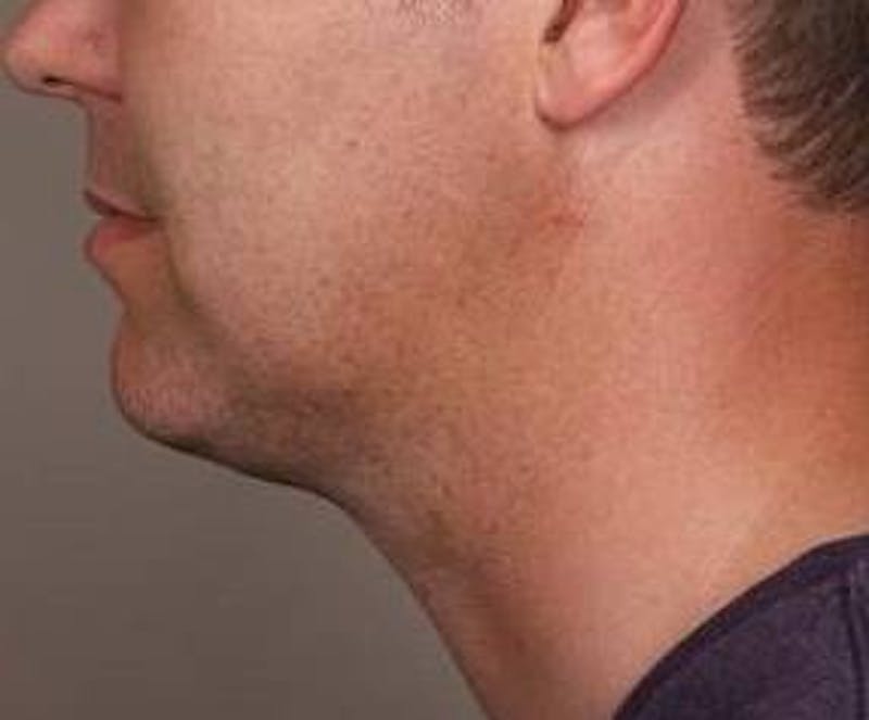 Liposuction Before & After Gallery - Patient 110585 - Image 4 - Scott Chapin, MD