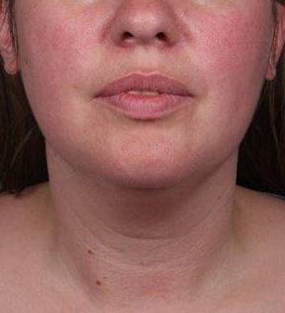 Liposuction Before & After Gallery - Patient 181881 - Image 1 - Scott Chapin, MD