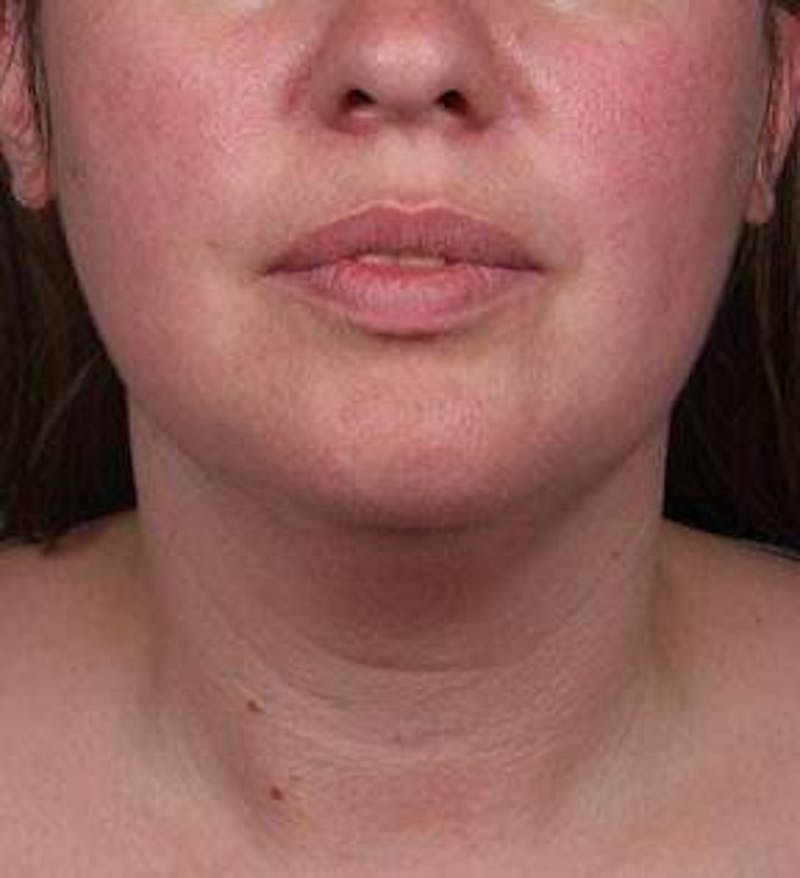 Liposuction Before & After Gallery - Patient 181881 - Image 1 - Scott Chapin, MD