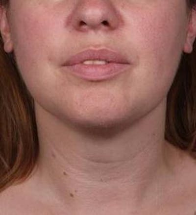 Liposuction Before & After Gallery - Patient 181881 - Image 2 - Scott Chapin, MD