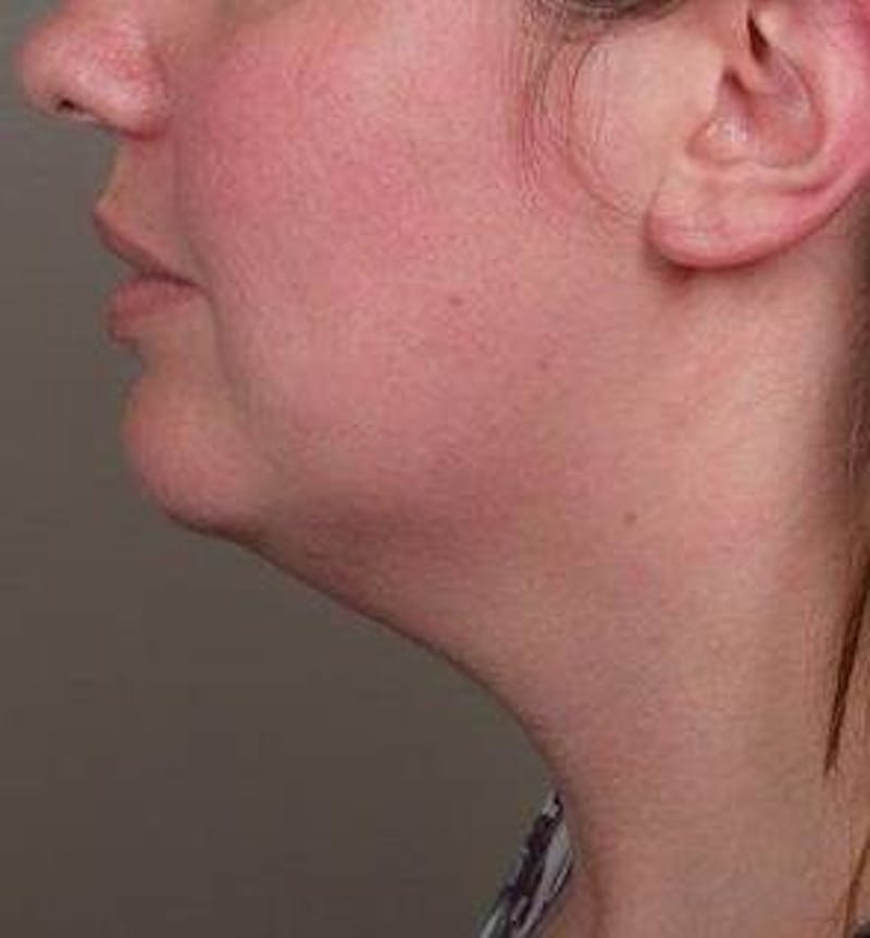 Liposuction Before & After Gallery - Patient 181881 - Image 3 - Scott Chapin, MD