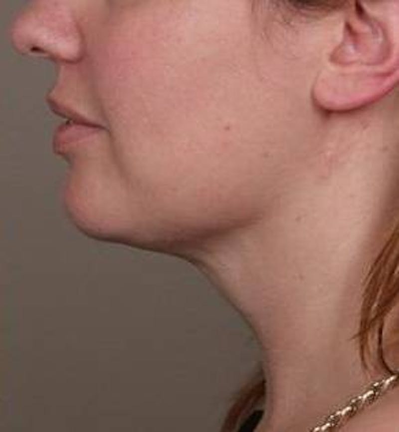 Liposuction Before & After Gallery - Patient 181881 - Image 4 - Scott Chapin, MD