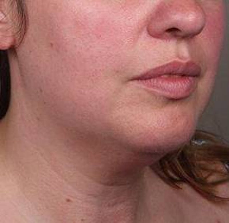 Liposuction Before & After Gallery - Patient 181881 - Image 5 - Scott Chapin, MD