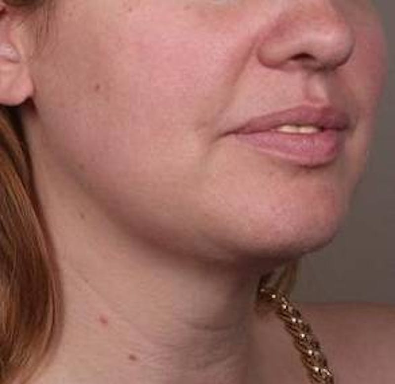 Liposuction Before & After Gallery - Patient 181881 - Image 6 - Scott Chapin, MD