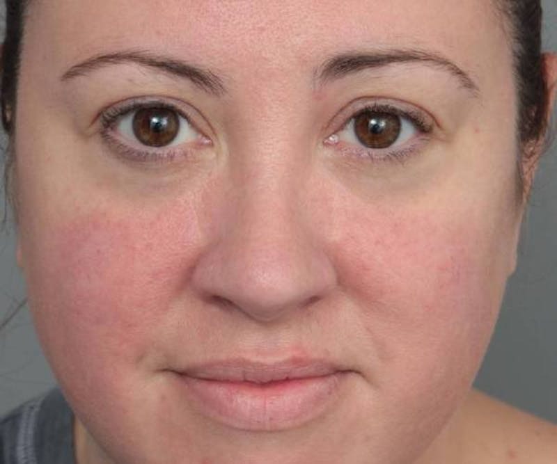 Liposuction Before & After Gallery - Patient 115071 - Image 2 - Scott Chapin, MD