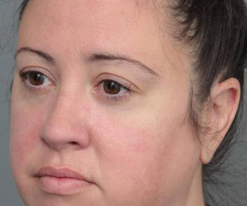 Liposuction Before & After Gallery - Patient 115071 - Image 3 - Scott Chapin, MD