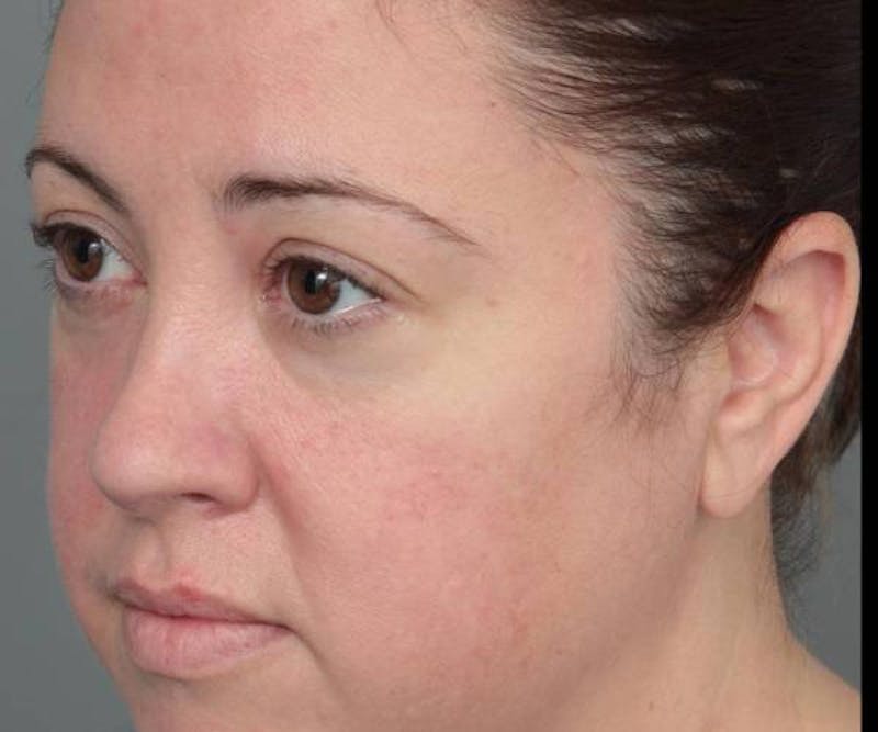 Liposuction Before & After Gallery - Patient 115071 - Image 4 - Scott Chapin, MD