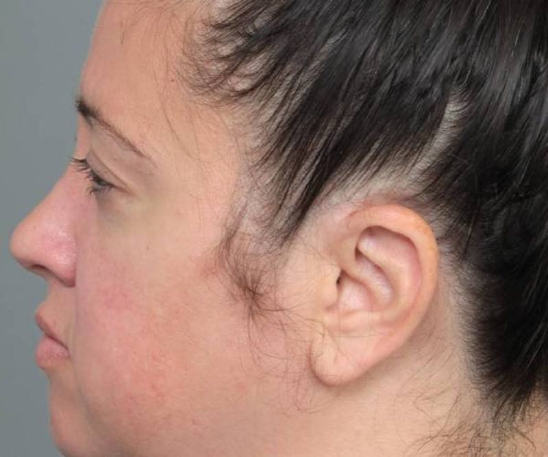 Liposuction Before & After Gallery - Patient 115071 - Image 5 - Scott Chapin, MD