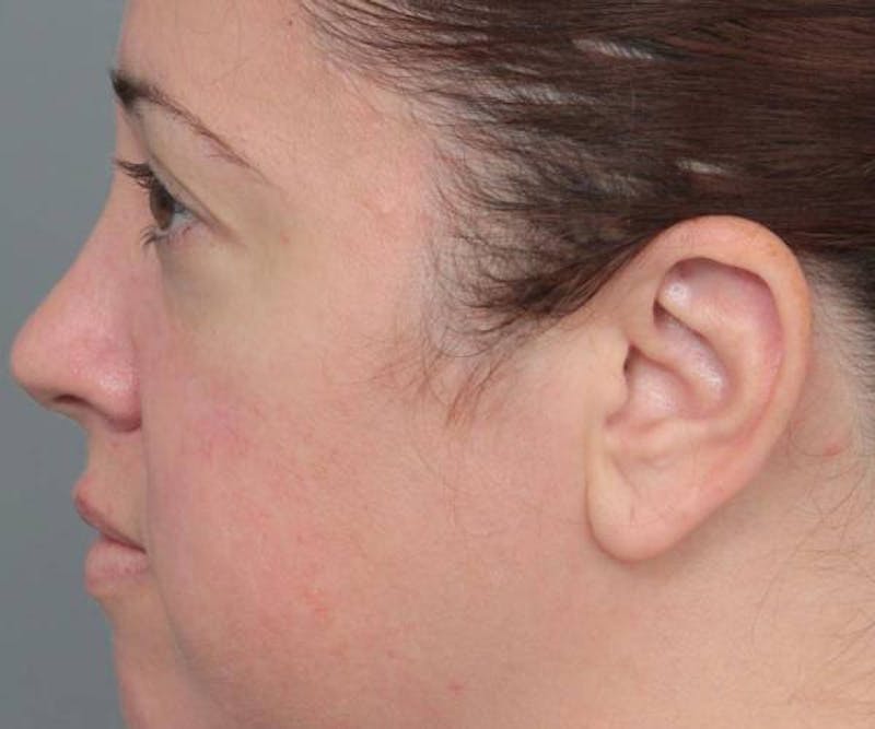 Liposuction Before & After Gallery - Patient 115071 - Image 6 - Scott Chapin, MD