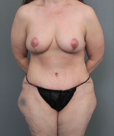 Mommy Makeover Before & After Gallery - Patient 271374 - Image 2 - Scott Chapin, MD