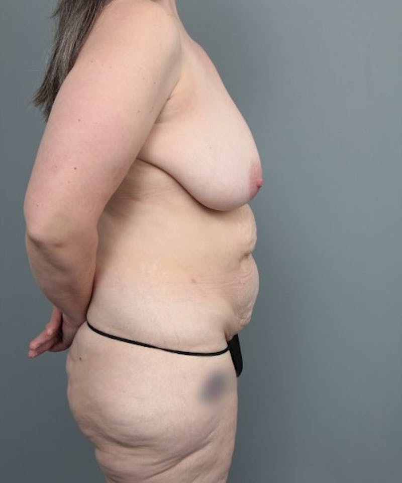 Mommy Makeover Before & After Gallery - Patient 271374 - Image 3 - Scott Chapin, MD