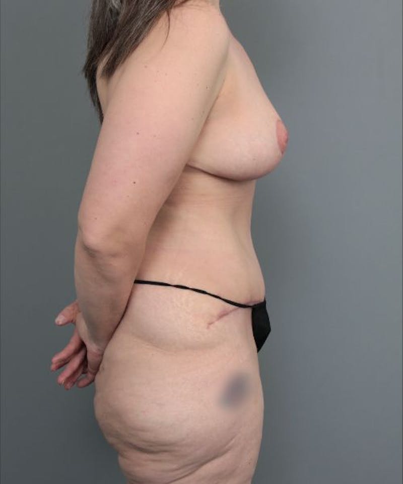 Mommy Makeover Before & After Gallery - Patient 271374 - Image 4 - Scott Chapin, MD