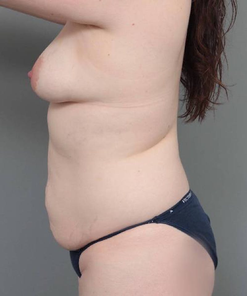 Mommy Makeover Before & After Gallery - Patient 967864 - Image 5 - Scott Chapin, MD