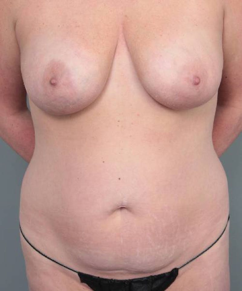 Mommy Makeover Before & After Gallery - Patient 838577 - Image 1 - Scott Chapin, MD