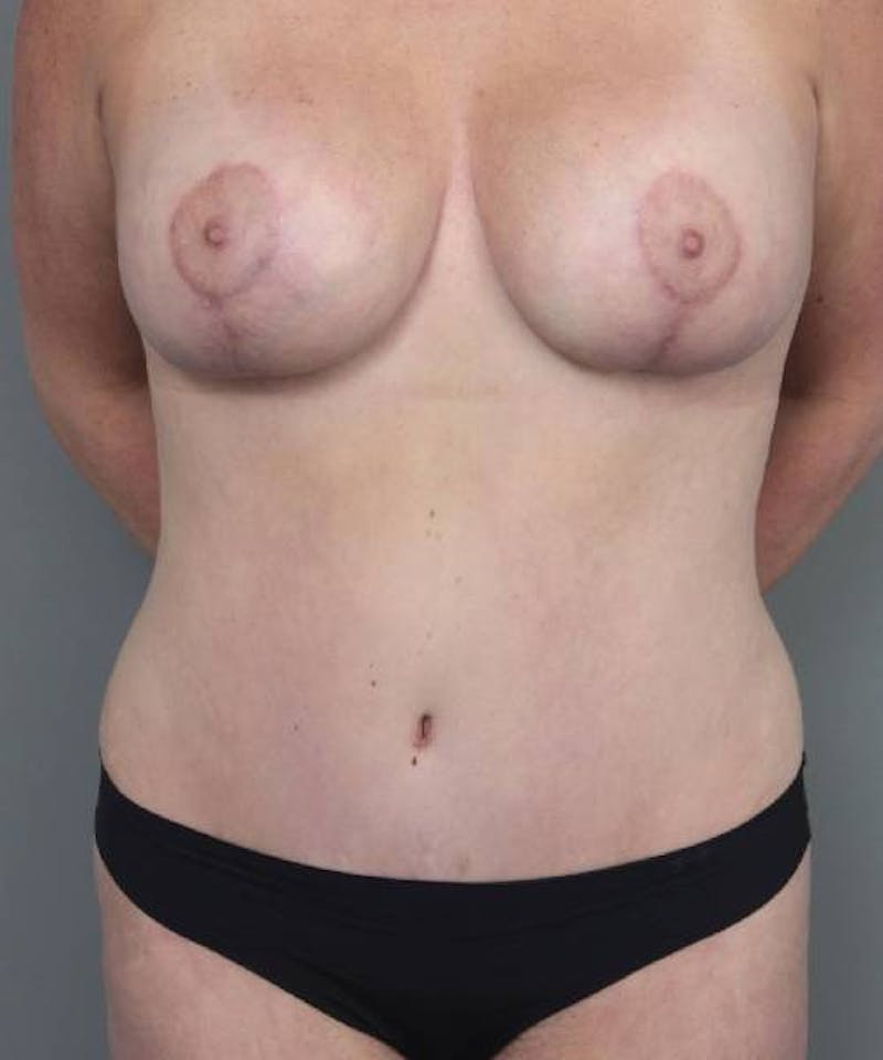 Mommy Makeover Before & After Gallery - Patient 838577 - Image 2 - Scott Chapin, MD