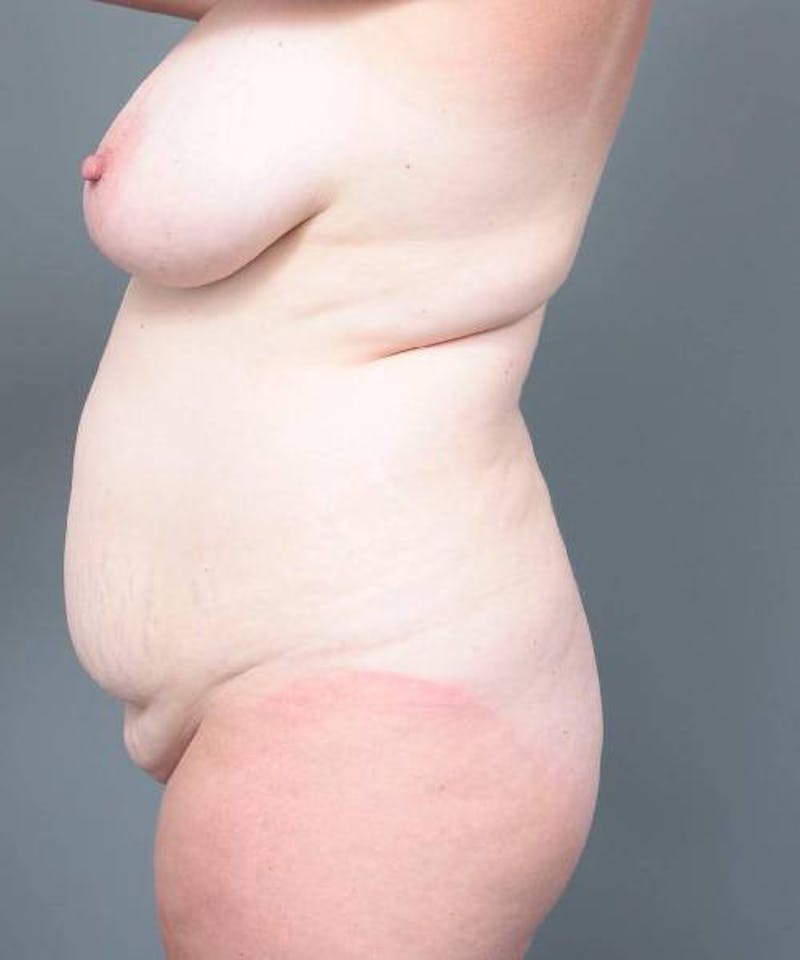 Mommy Makeover Before & After Gallery - Patient 123292 - Image 3 - Scott Chapin, MD