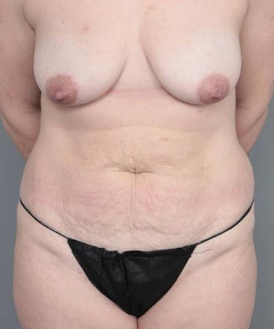 Mommy Makeover Before & After Gallery - Patient 291043 - Image 1 - Scott Chapin, MD