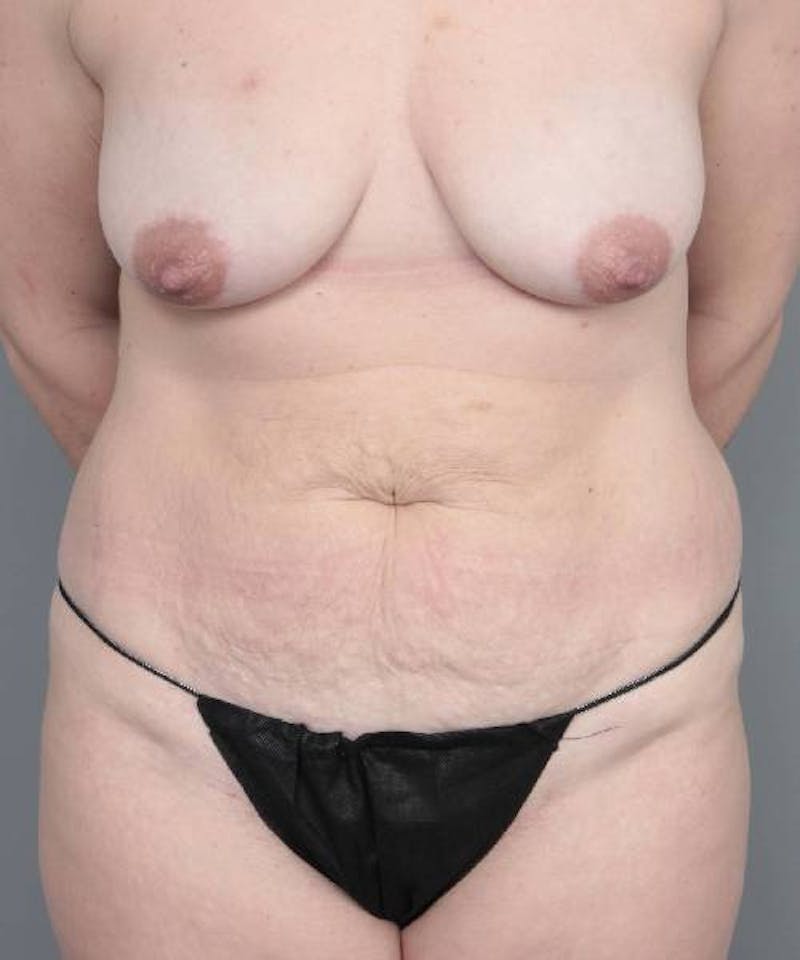 Mommy Makeover Before & After Gallery - Patient 291043 - Image 1 - Scott Chapin, MD