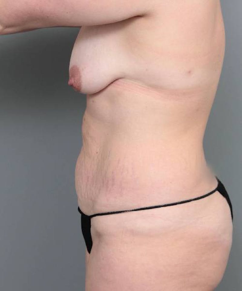 Mommy Makeover Before & After Gallery - Patient 291043 - Image 3 - Scott Chapin, MD